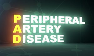 PAD treatment doctors recommend